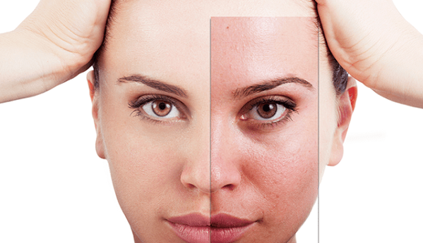 фракційне омолодження прибирає основні естетичні дефекти на обличчі
