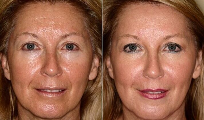 до і після омолодженія шкіри обличчя в домашніх умовах