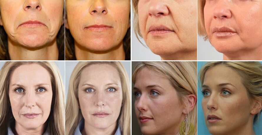 фото жінок до і після омолодження шкіри обличчя